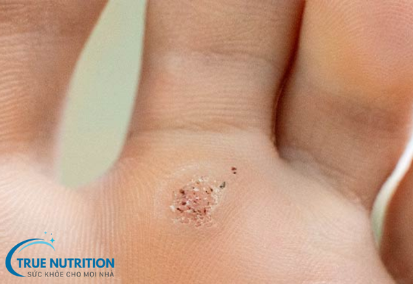 Mụn Cóc: Những Điều Bạn Cần Biết Về Nguyên Nhân và Cách Điều Trị