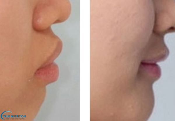 Bệnh Răng Vẩu Nặng Là Gì? Cách Điều Trị Giúp Lấy Lại Nụ Cười Tự Tin
