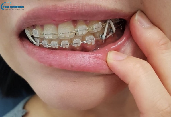 Bệnh Răng Vẩu Nặng Là Gì? Cách Điều Trị Giúp Lấy Lại Nụ Cười Tự Tin