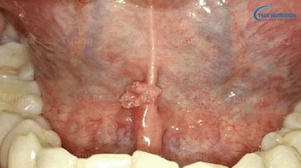 Dưới Lưỡi Nổi Cục Thịt: Nguyên Nhân, Điều Trị, Bệnh Lý
