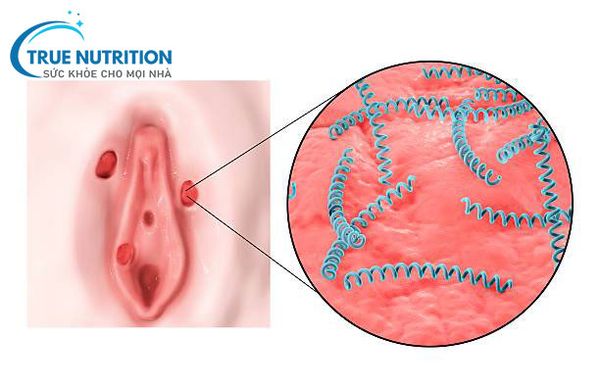 Khám Phá bí ẩn kinh hoàng về Giang Mai?!