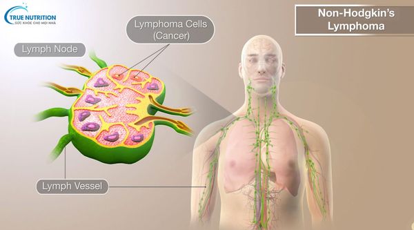 U Lympho Không Hodgkin sống được bao lâu?