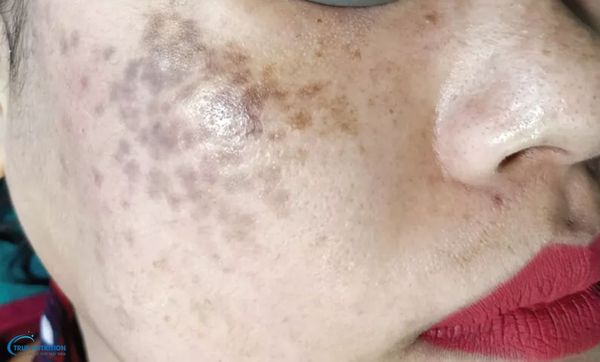 Bớt Hori Là Gì, Có Chữa Được Không, Xuất Hiện Ở Độ Tuổi Nào?