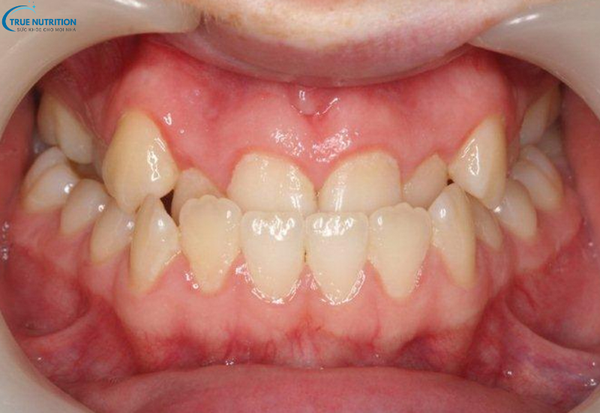 Điều Trị Khớp Cắn Ngược: Các Phương Pháp Hiện Đại Đem Lại Nụ Cười Đẹp