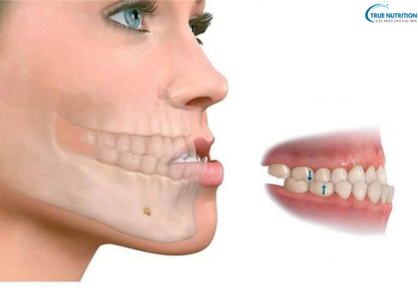 Điều Trị Khớp Cắn Ngược: Các Phương Pháp Hiện Đại Đem Lại Nụ Cười Đẹp