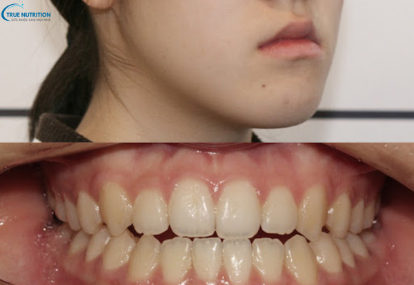 Điều Trị Khớp Cắn Ngược: Các Phương Pháp Hiện Đại Đem Lại Nụ Cười Đẹp