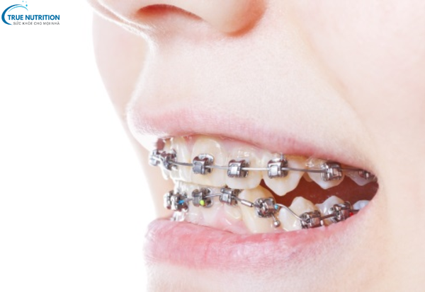 Điều Trị Khớp Cắn Ngược: Các Phương Pháp Hiện Đại Đem Lại Nụ Cười Đẹp