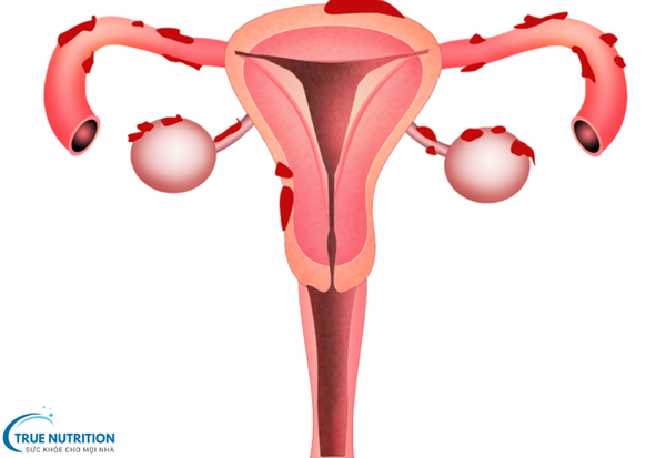 Bệnh Lạc Nội Mạc Tử Cung: Dấu Hiệu Nhận Biết, Cách Điều Trị Tối Ưu