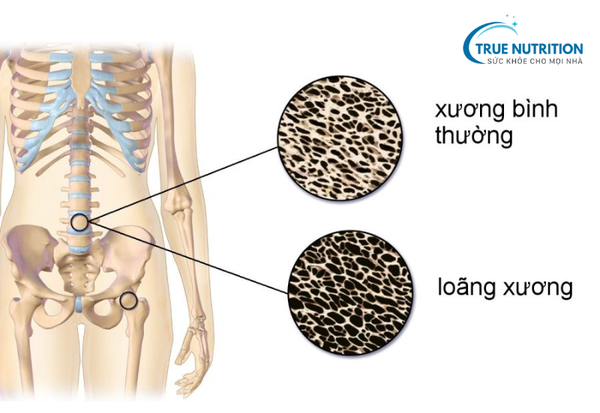 loãng xương