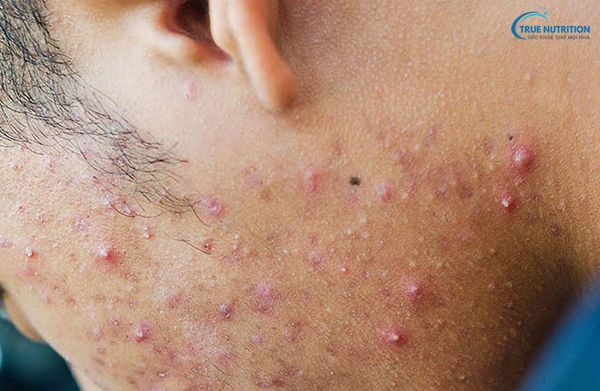 Nhận Diện Hình Ảnh Viêm Nang Lông, Nguyên Nhân, Điều Trị