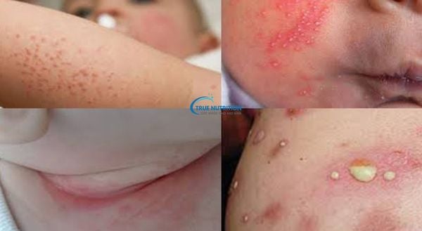 Hình Ảnh Viêm Da Mủ Ở Trẻ Em: Nhận Biết, Điều Trị và Phòng Ngừa