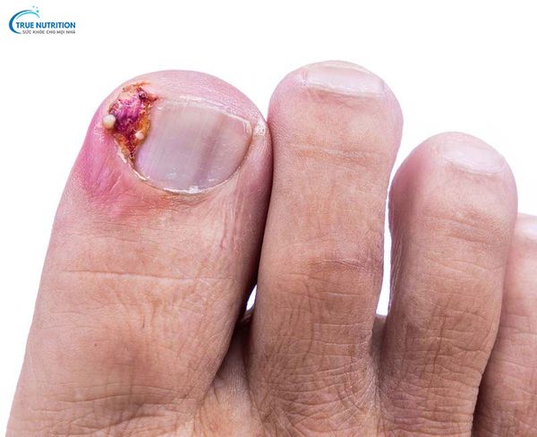 Cách Chữa Chín Mé Bằng Kem Đánh Răng Khoa Học Nói Gì?