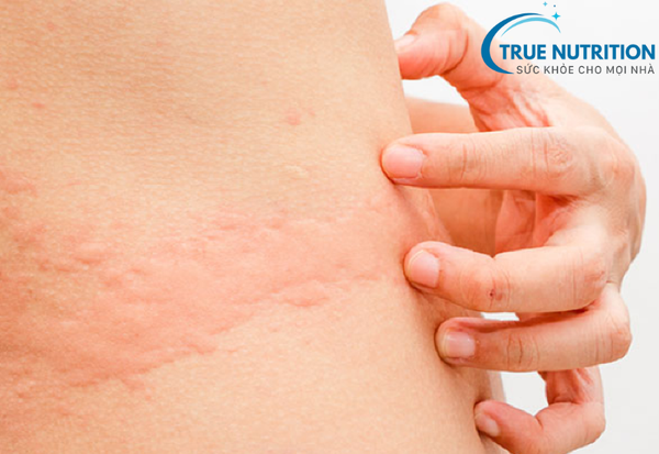 Mề Đay Là Gì? Cách Ngăn Ngừa Và Điều Trị Giúp Giảm Ngứa Nhanh Chóng
