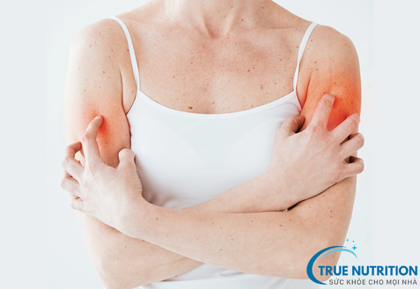 Mề Đay Là Gì? Cách Ngăn Ngừa Và Điều Trị Giúp Giảm Ngứa Nhanh Chóng