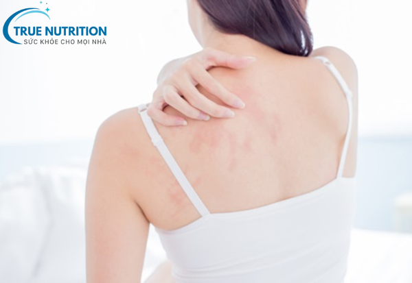 Mề Đay Là Gì? Cách Ngăn Ngừa Và Điều Trị Giúp Giảm Ngứa Nhanh Chóng