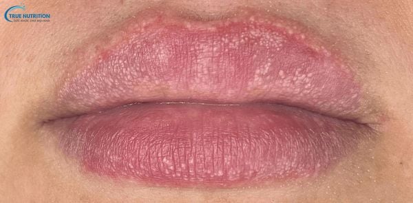 Cách Chữa Nổi Hạt Fordyce Trên Môi: Mẹo, Công Nghệ, Sinh Hoạt