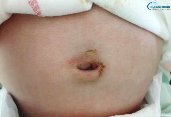 Bệnh U Hạt Rốn: Những Điều Cần Biết Và Phương Pháp Xử Lý An Toàn