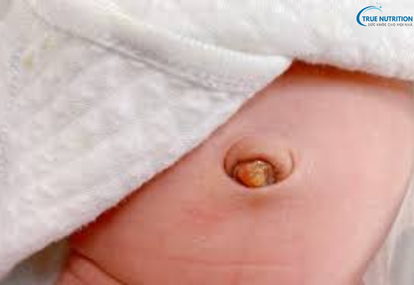 Bệnh U Hạt Rốn: Những Điều Cần Biết Và Phương Pháp Xử Lý An Toàn