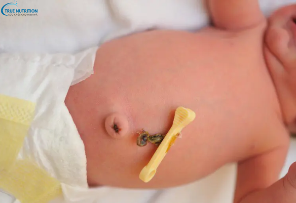 Bệnh U Hạt Rốn: Những Điều Cần Biết Và Phương Pháp Xử Lý An Toàn