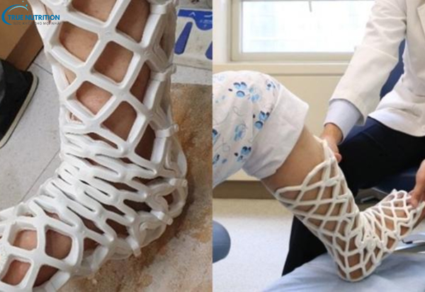 Biến Chứng Bó Bột: Hướng Dẫn Chăm Sóc Để Tránh Rủi Ro Sức Khỏe