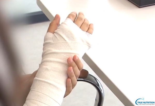 Biến Chứng Bó Bột: Hướng Dẫn Chăm Sóc Để Tránh Rủi Ro Sức Khỏe