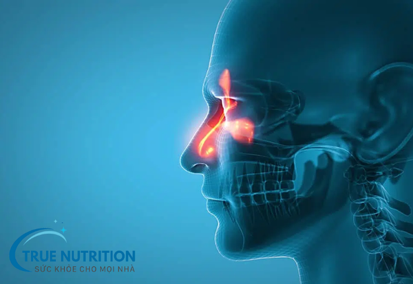 Bệnh Viêm Xoang Mũi – Nguyên Nhân, Triệu Chứng và Cách Điều Trị