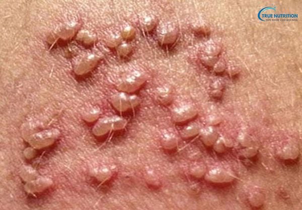 Hạt Fordyce ở vùng kín nữ: Nguyên nhân, dấu hiệu và cách điều trị