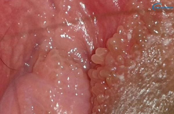 Hạt Fordyce ở vùng kín nữ: Nguyên nhân, dấu hiệu và cách điều trị