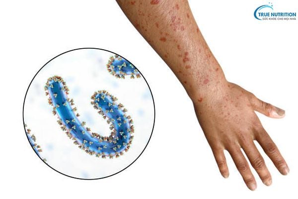 Mẹo Dân Gian Chữa Sốt Phát Ban: Hiệu Quả, An Toàn Và Dễ Áp Dụng