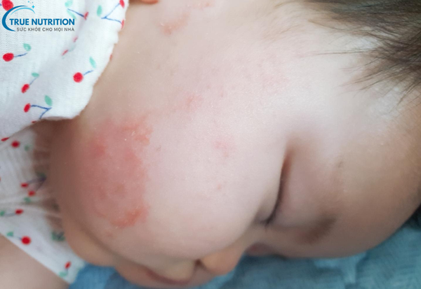 Nấm Da: Dấu Hiệu Nhận Biết và Bí Quyết Điều Trị Triệt Để