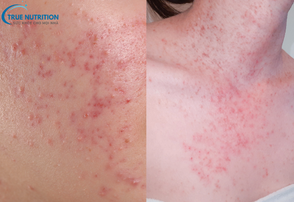 Nấm Da: Dấu Hiệu Nhận Biết và Bí Quyết Điều Trị Triệt Để