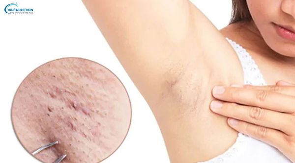 Nhận Diện Hình Ảnh Viêm Nang Lông, Nguyên Nhân, Điều Trị
