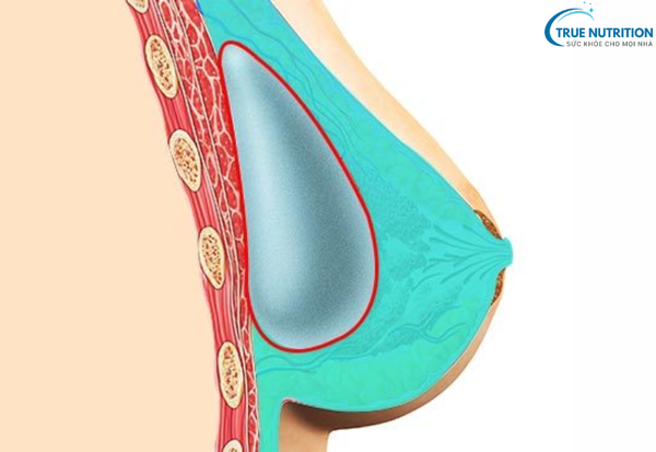 Nâng Ngực - Bí Quyết Thăng Hạng Nhan Sắc Phái Đẹp Hiện Đại