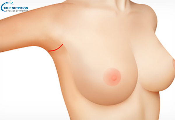 Nâng Ngực - Bí Quyết Thăng Hạng Nhan Sắc Phái Đẹp Hiện Đại