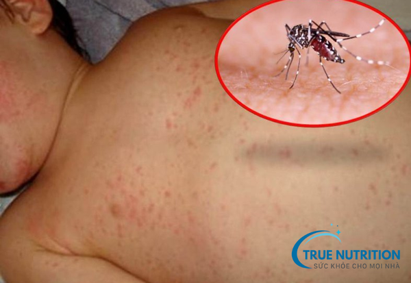 Sốt xuất huyết: Những điều cần biết và cách phòng ngừa