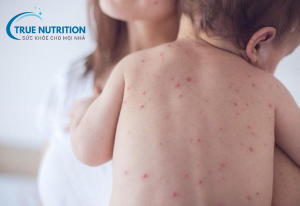 Sốt xuất huyết: Những điều cần biết và cách phòng ngừa