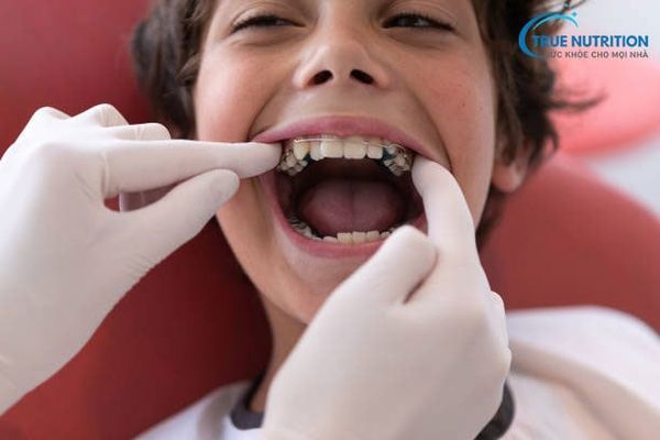 Nhận Diện Hình Ảnh Răng Mọc Lẫy: Xử Lý, Giá Nhổ Răng