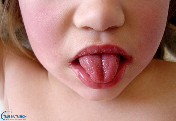 Bệnh Lưỡi Trẻ Bị Nổi Hạt Đỏ: Phương Pháp Chăm Sóc và Điều Trị Cho Bé