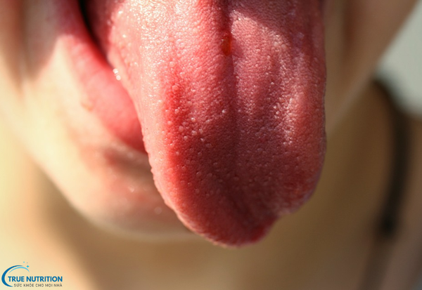 Bệnh Lưỡi Trẻ Bị Nổi Hạt Đỏ: Phương Pháp Chăm Sóc và Điều Trị Cho Bé