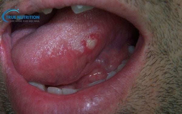 Lưỡi Nổi Mụn Thịt Nguy Hiểm Không? Nguyên Nhân, Bệnh Lý?