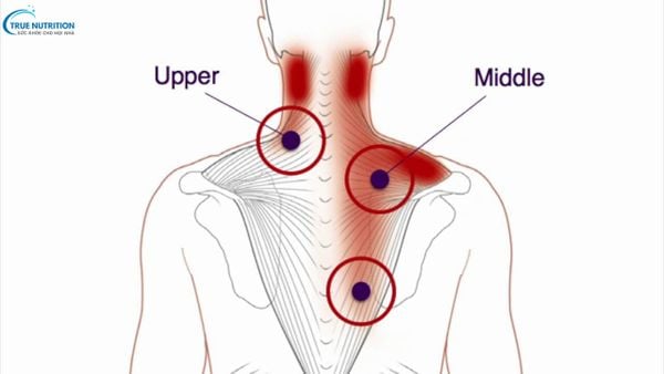 Trigger Point Là Gì? Nguyên Nhân & Liệu Pháp Điều Trị