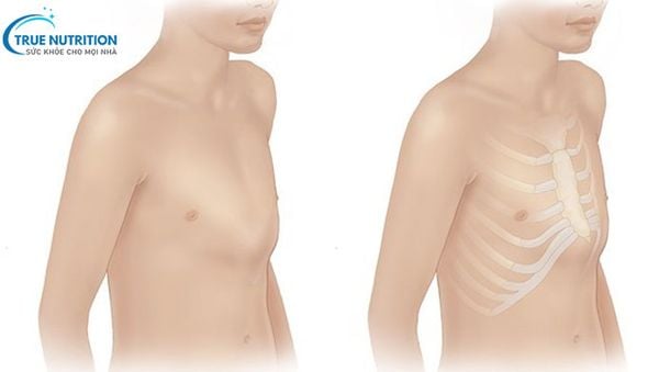 Hình Ảnh Trẻ Bị Nhô Xương Ức Gà: Nguyên Nhân & Phương Pháp Điều Trị
