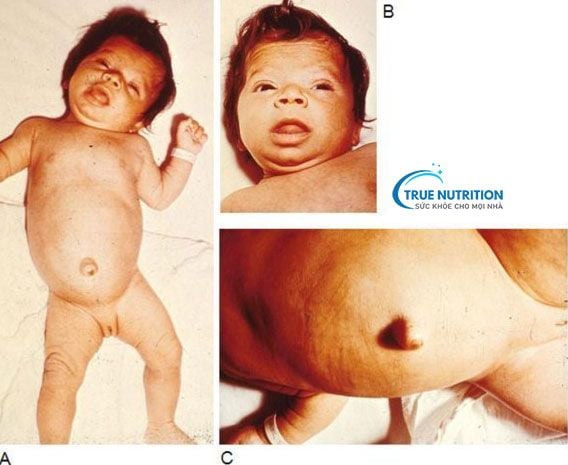 Nhận Diện Hình Ảnh Trẻ Bị Suy Giáp Bẩm Sinh