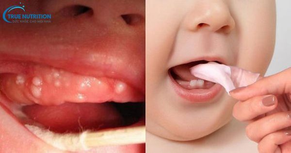Hình Ảnh Nanh Sữa Ở Trẻ Sơ Sinh: Hình Thái, Xử Lý