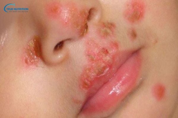 Hình Ảnh Viêm Da Mủ Ở Trẻ Em: Nhận Biết, Điều Trị và Phòng Ngừa