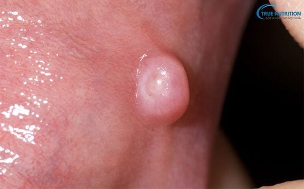 Hình Ảnh Mụn Thịt Trong Miệng: Nguyên Nhân, Điều Trị và Phòng Ngừa