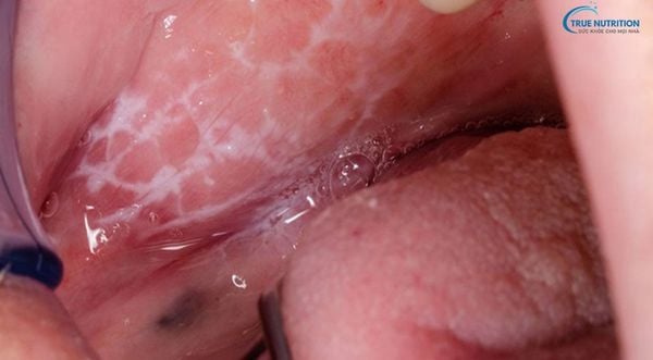 Lớp Màng Nhầy Màu Trắng Bên Trong Miệng Nguyên Nhân, Triệu Chứng và Cách Xử Lý