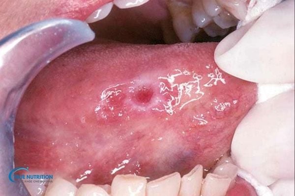 Lớp Màng Nhầy Màu Trắng Bên Trong Miệng Nguyên Nhân, Triệu Chứng và Cách Xử Lý