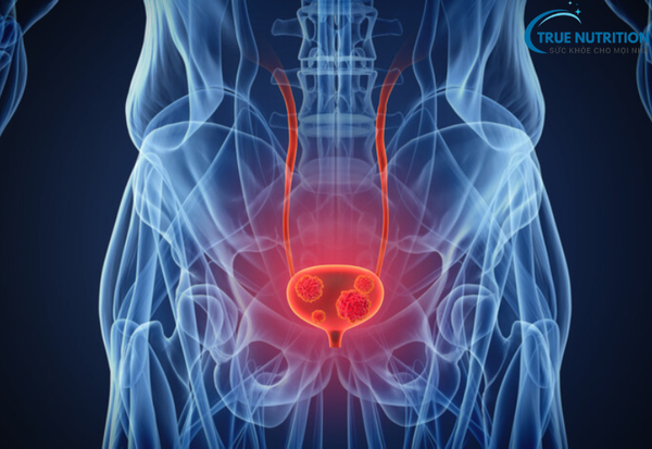 Nhiễm Trùng Đường Tiết Niệu: Cảnh Báo Triệu Chứng&nbsp; Và Cách Phòng Ngừa