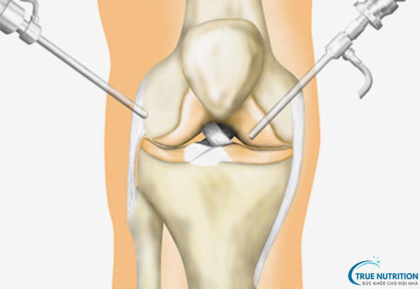 Nội Soi Khớp Gối: Phương Pháp Chẩn Đoán Và Điều Trị Các Bệnh Lý Khớp